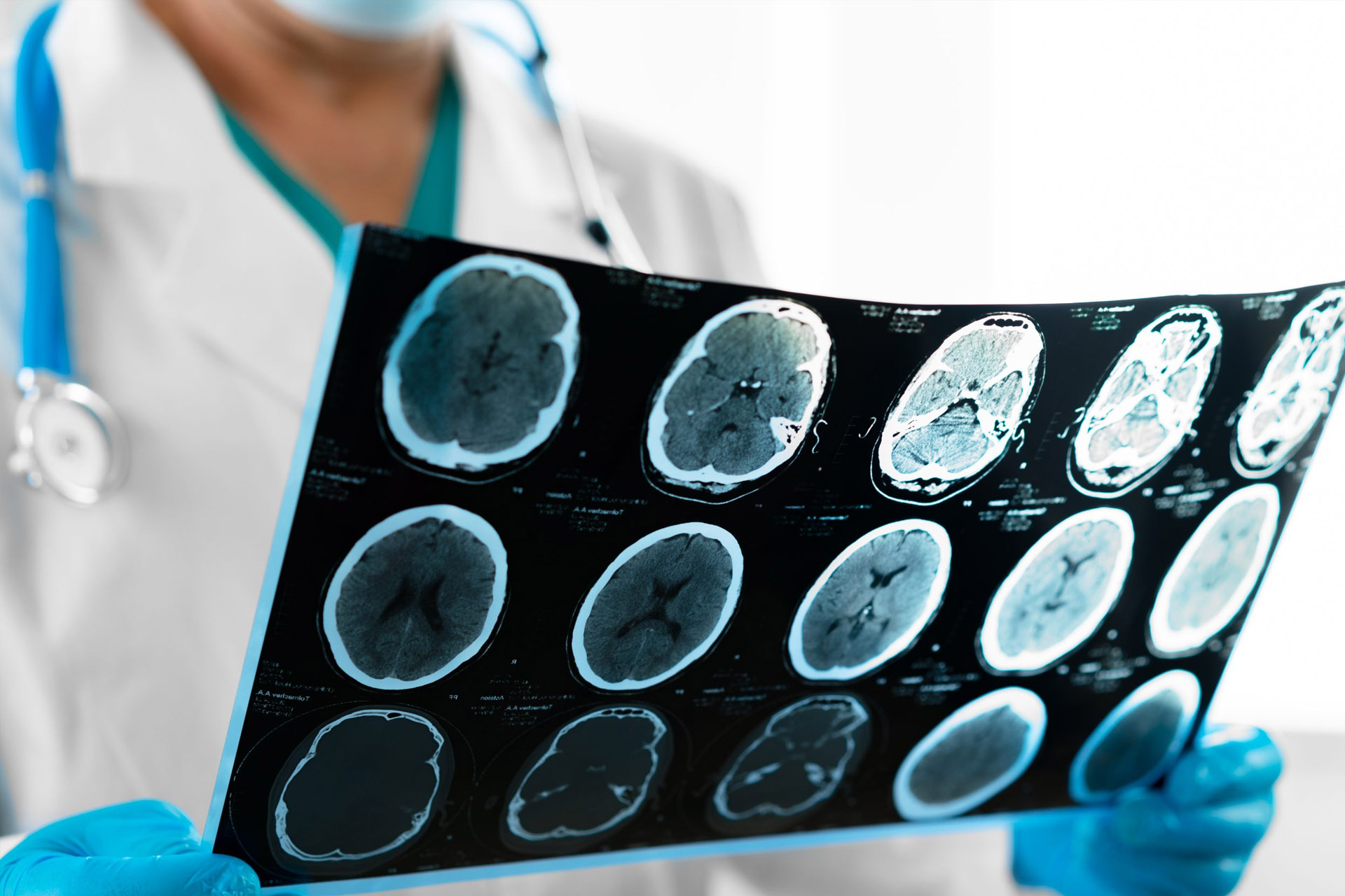 MRI of Traumatic Brain Injury Victim San Bernardino