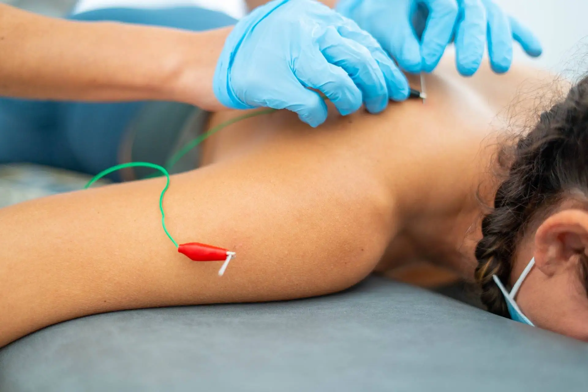 A closeup shot of a doctor putting acupuncture needles in the back skin of a woman