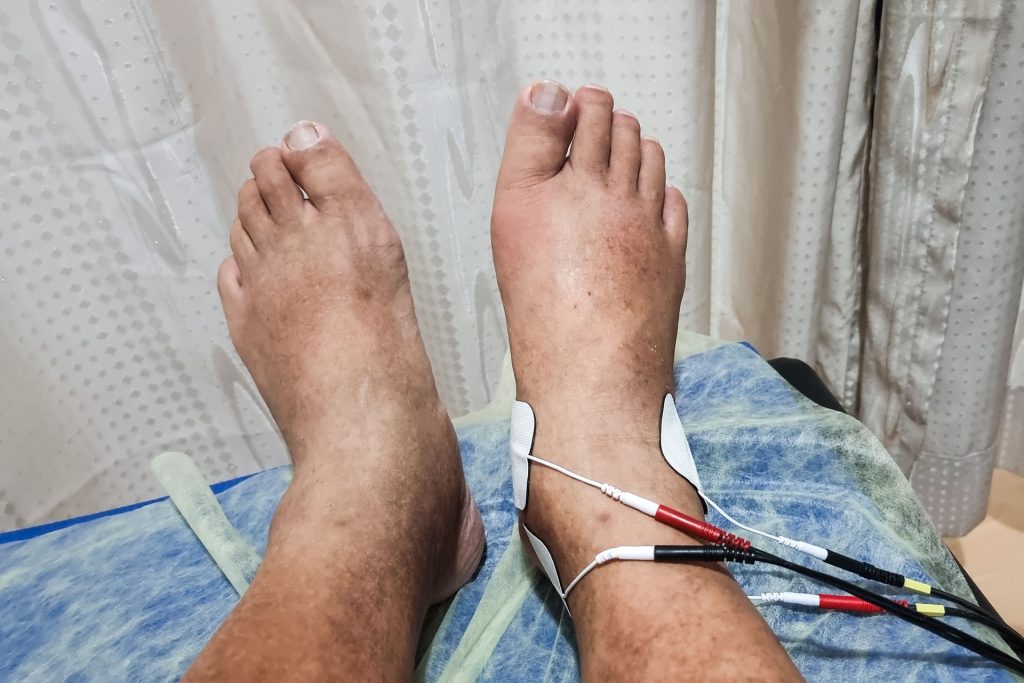 male feet at the end of a hospital bed being treated for crps